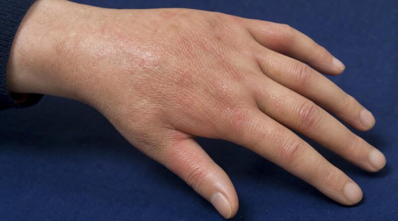 Scleroderma in Canada: Symptoms, Diagnosis, and Treatments That Truly Make a Difference Scleroderma in Canada: Symptoms, Diagnosis, and Treatments That Truly Make a Difference
